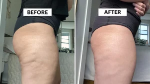 before and after revitol cellulite cream usage