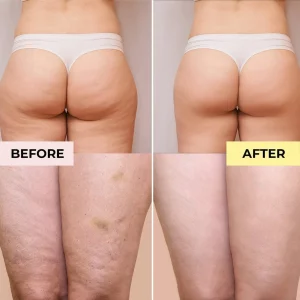 revitol cellulite cream before and after