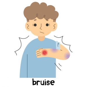 vitamin c deficiency causes bruising